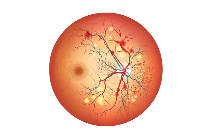 Лечение возрастной макулярной дегенерации  Лечение возрастной макулярной дегенерации